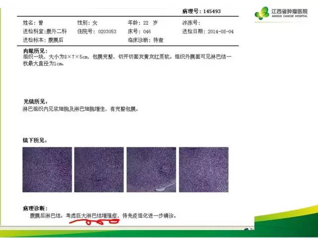 【病例】腹膜后巨淋巴增生症1例CT影像表现