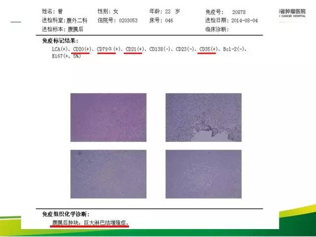【病例】腹膜后巨淋巴增生症1例CT影像表现