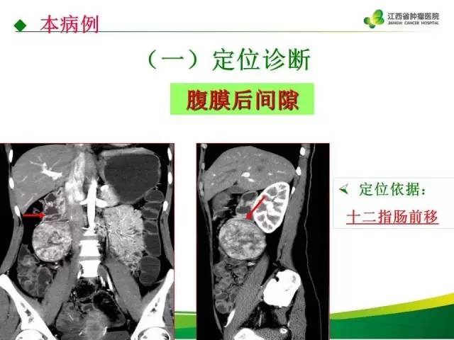 【病例】腹膜后巨淋巴增生症1例CT影像表现