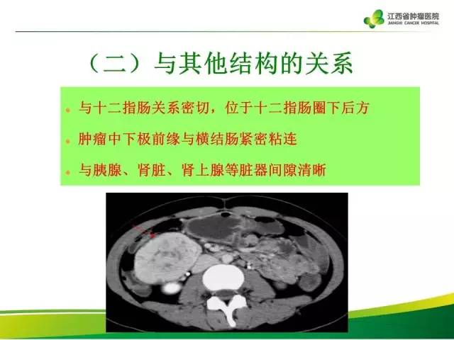 【病例】腹膜后巨淋巴增生症1例CT影像表现