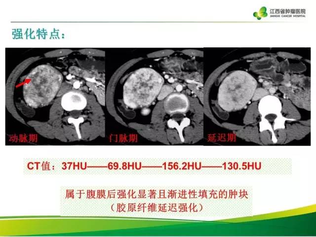 【病例】腹膜后巨淋巴增生症1例CT影像表现