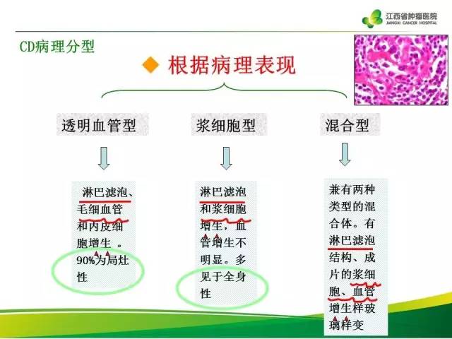 【病例】腹膜后巨淋巴增生症1例CT影像表现