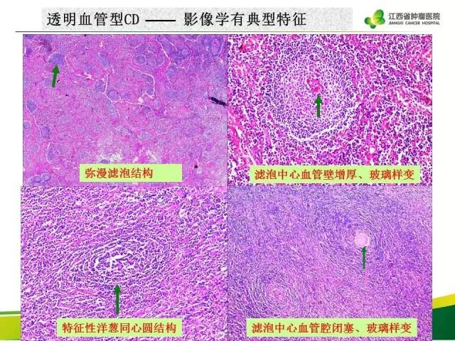 【病例】腹膜后巨淋巴增生症1例CT影像表现