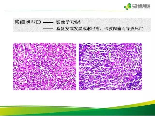 【病例】腹膜后巨淋巴增生症1例CT影像表现