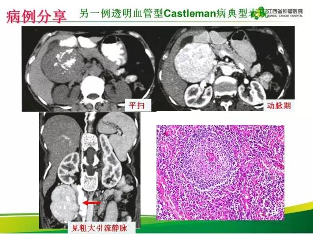 【病例】腹膜后巨淋巴增生症1例CT影像表现