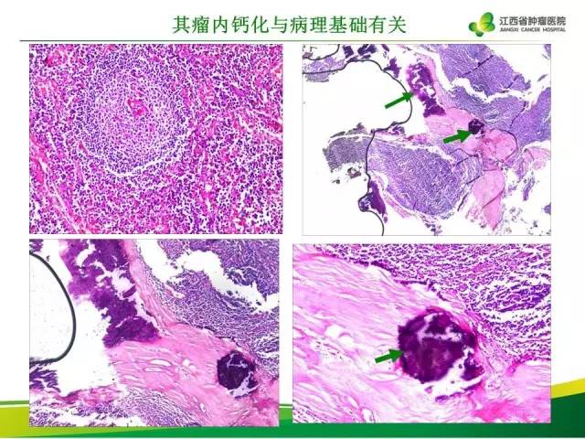 【病例】腹膜后巨淋巴增生症1例CT影像表现