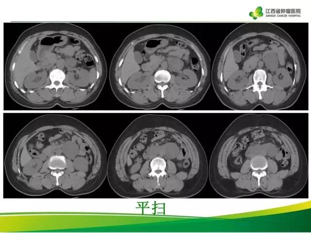 【病例】腹膜后神经鞘瘤1例CT影像表现