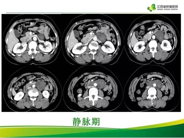 【病例】腹膜后神经鞘瘤1例CT影像表现