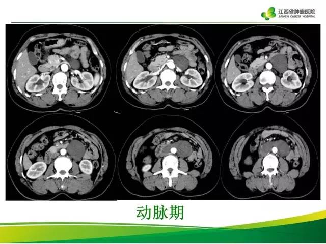 【病例】腹膜后神经鞘瘤1例CT影像表现