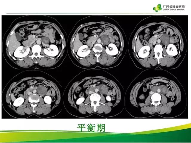 【病例】腹膜后神经鞘瘤1例CT影像表现