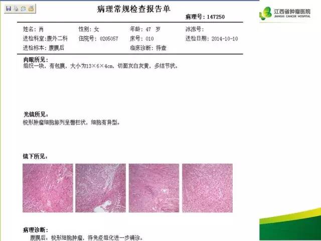 【病例】腹膜后神经鞘瘤1例CT影像表现