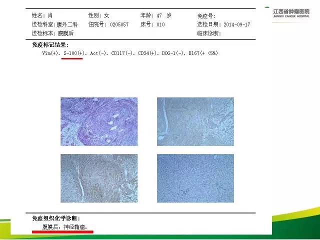 【病例】腹膜后神经鞘瘤1例CT影像表现