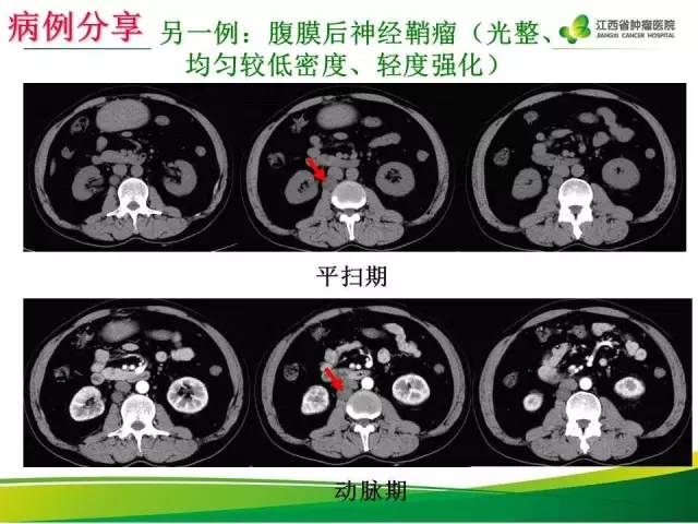 【病例】腹膜后神经鞘瘤1例CT影像表现