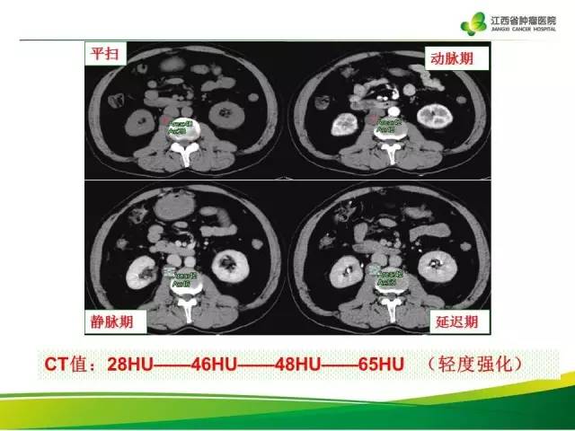 【病例】腹膜后神经鞘瘤1例CT影像表现