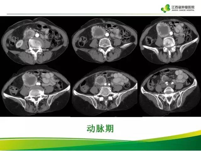 【病例】腹膜后胃肠道间质瘤1例CT影像表现