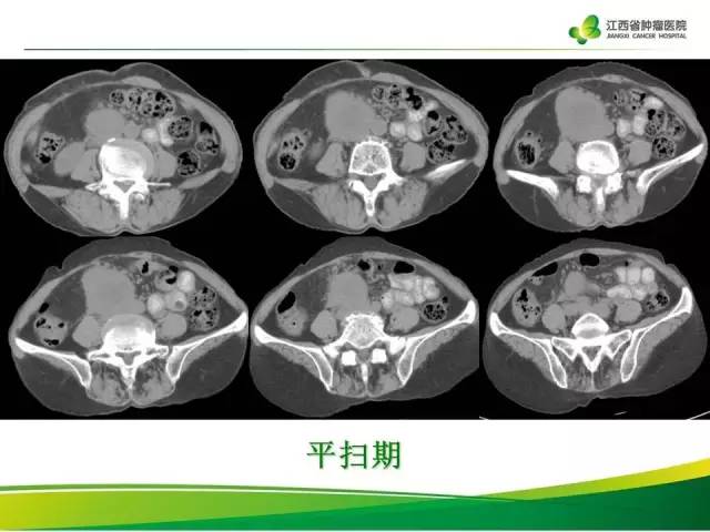 【病例】腹膜后胃肠道间质瘤1例CT影像表现