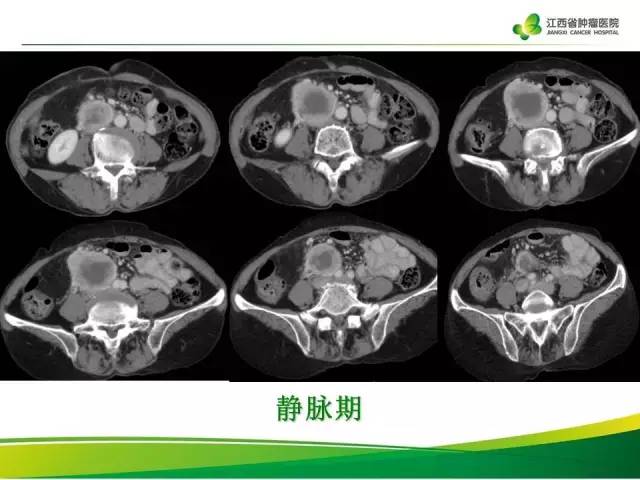 【病例】腹膜后胃肠道间质瘤1例CT影像表现