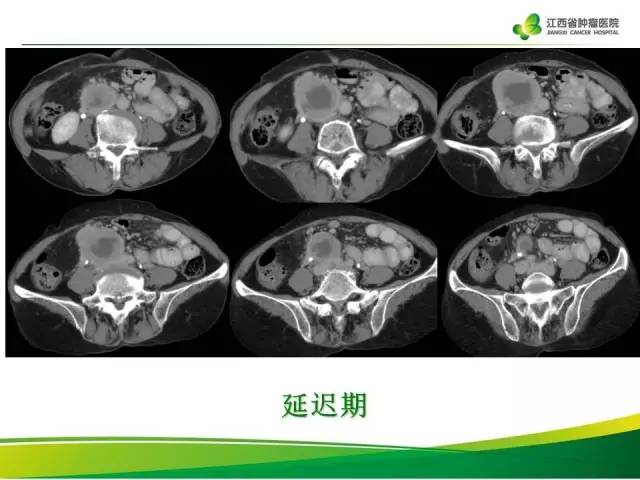 【病例】腹膜后胃肠道间质瘤1例CT影像表现