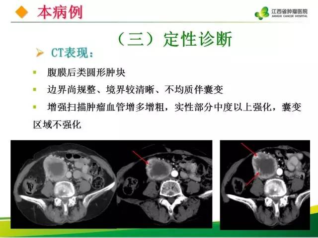 【病例】腹膜后胃肠道间质瘤1例CT影像表现