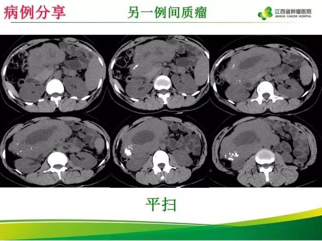 【病例】腹膜后胃肠道间质瘤1例CT影像表现