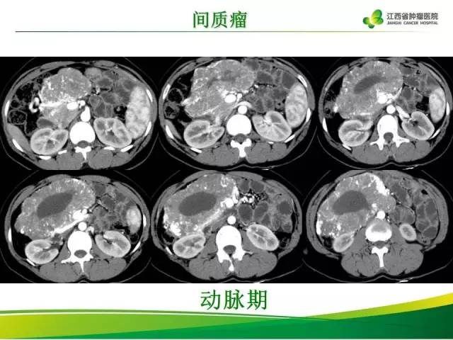 【病例】腹膜后胃肠道间质瘤1例CT影像表现