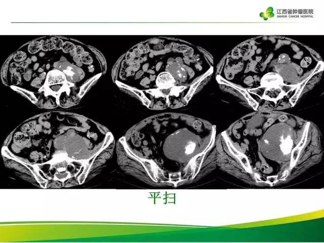 【病例】腹膜后脂肪肉瘤1例CT影像分析