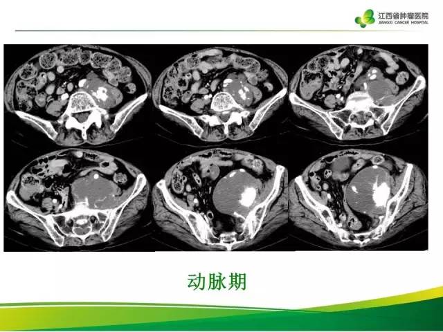 【病例】腹膜后脂肪肉瘤1例CT影像分析