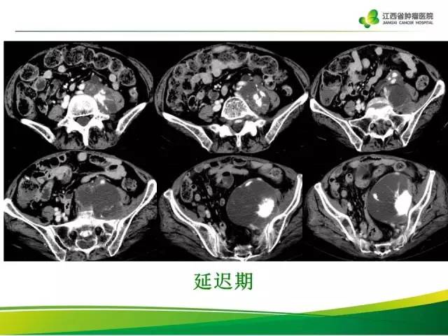 【病例】腹膜后脂肪肉瘤1例CT影像分析