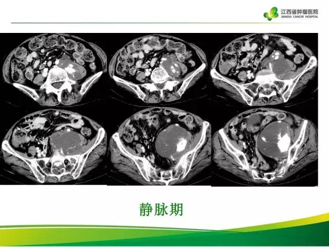【病例】腹膜后脂肪肉瘤1例CT影像分析
