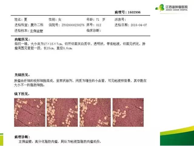 【病例】腹膜后脂肪肉瘤1例CT影像分析