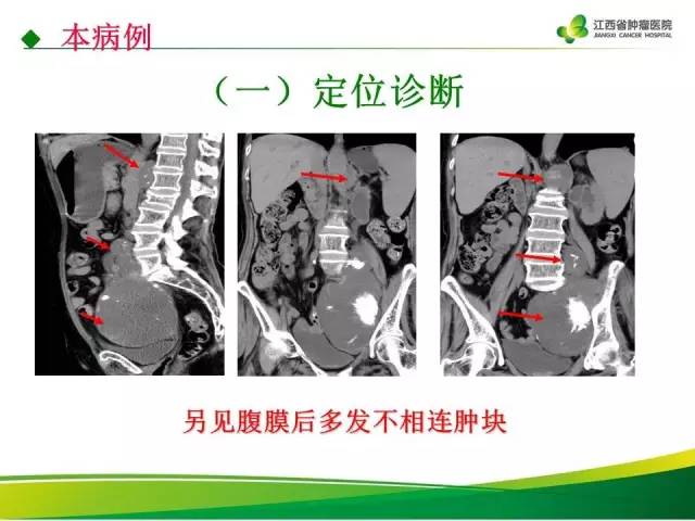 【病例】腹膜后脂肪肉瘤1例CT影像分析