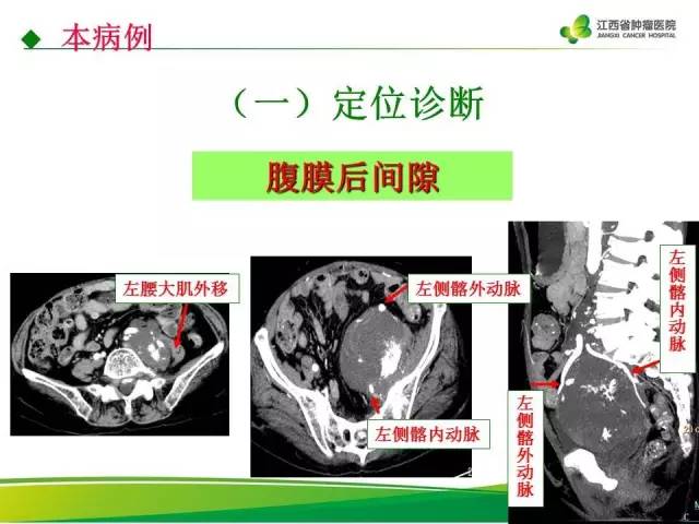 【病例】腹膜后脂肪肉瘤1例CT影像分析