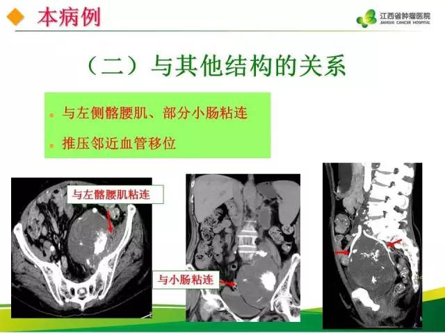 【病例】腹膜后脂肪肉瘤1例CT影像分析
