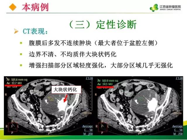 【病例】腹膜后脂肪肉瘤1例CT影像分析