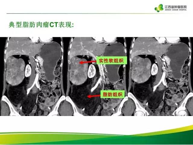 【病例】腹膜后脂肪肉瘤1例CT影像分析
