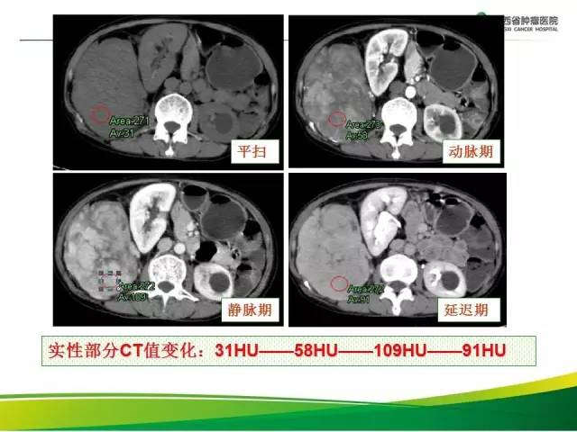 【病例】腹膜后脂肪肉瘤1例CT影像分析