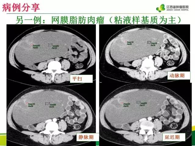 【病例】腹膜后脂肪肉瘤1例CT影像分析