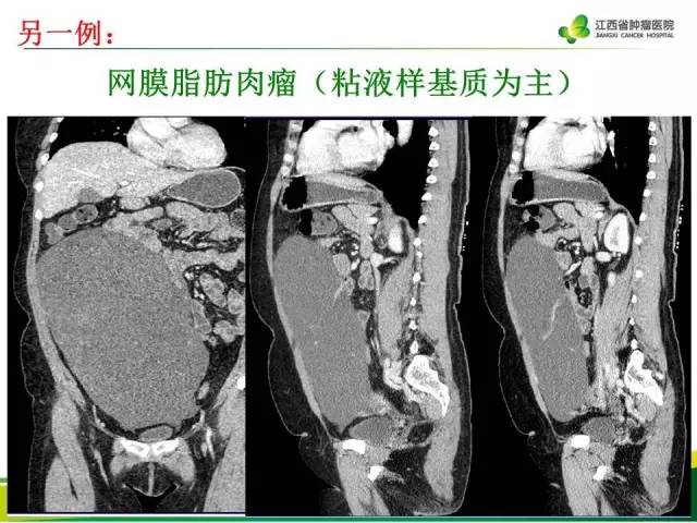 【病例】腹膜后脂肪肉瘤1例CT影像分析
