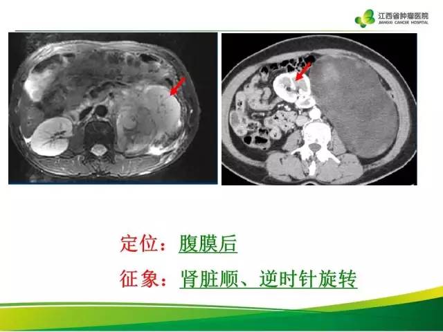 【病例】腹膜后脂肪肉瘤1例CT影像分析