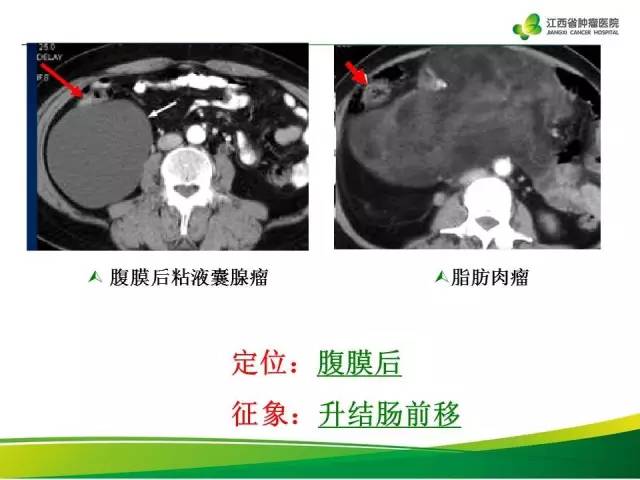 【病例】腹膜后脂肪肉瘤1例CT影像分析