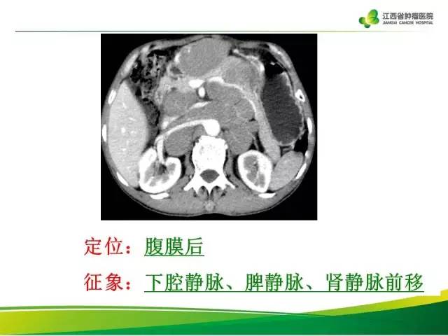 【病例】腹膜后脂肪肉瘤1例CT影像分析