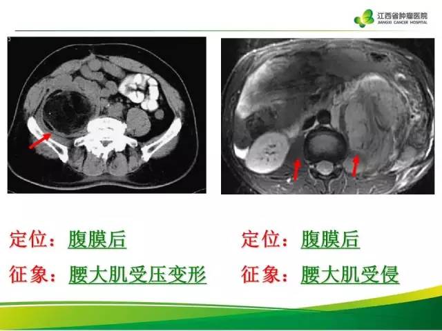 【病例】腹膜后脂肪肉瘤1例CT影像分析