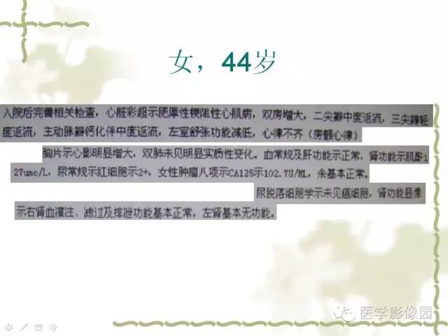 【病例】肾周淋巴瘤1例CT影像表现