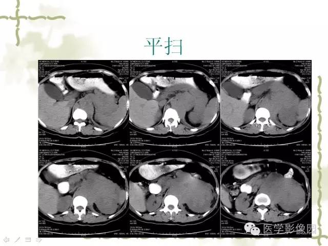 【病例】肾周淋巴瘤1例CT影像表现