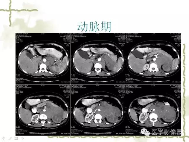 【病例】肾周淋巴瘤1例CT影像表现