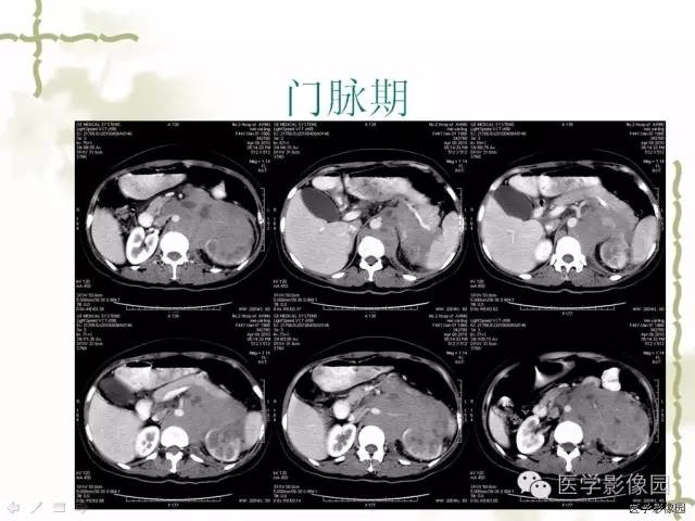 【病例】肾周淋巴瘤1例CT影像表现