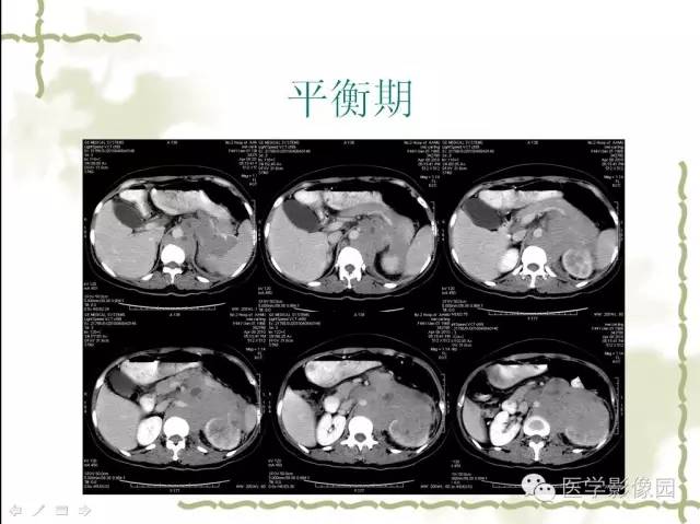 【病例】肾周淋巴瘤1例CT影像表现