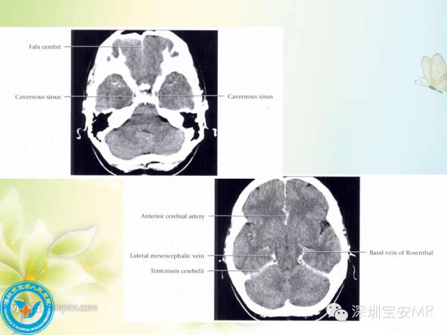 【PPT】颅内静脉系统影像CT,MRI及DSA解剖