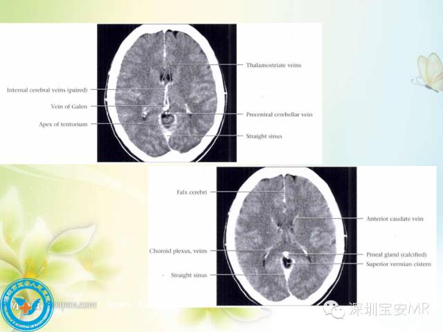 【PPT】颅内静脉系统影像CT,MRI及DSA解剖