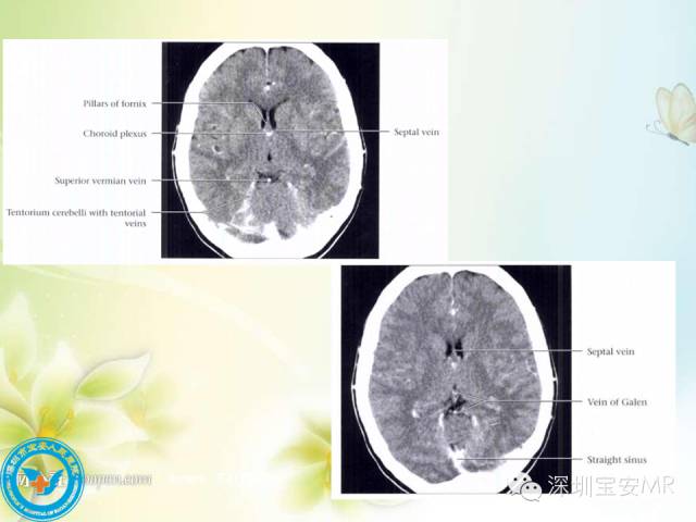 【PPT】颅内静脉系统影像CT,MRI及DSA解剖